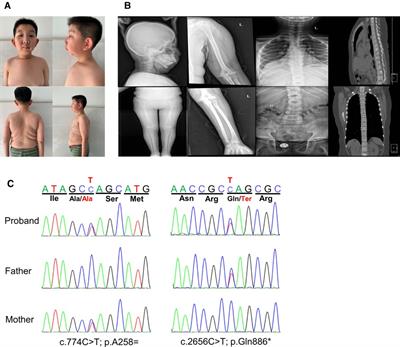 Clinical and molecular characterization of a patient with MBTPS1 related spondyloepiphyseal dysplasia: Evidence of pathogenicity for a synonymous variant